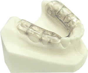 Lower Occlusal Acrylic Splint